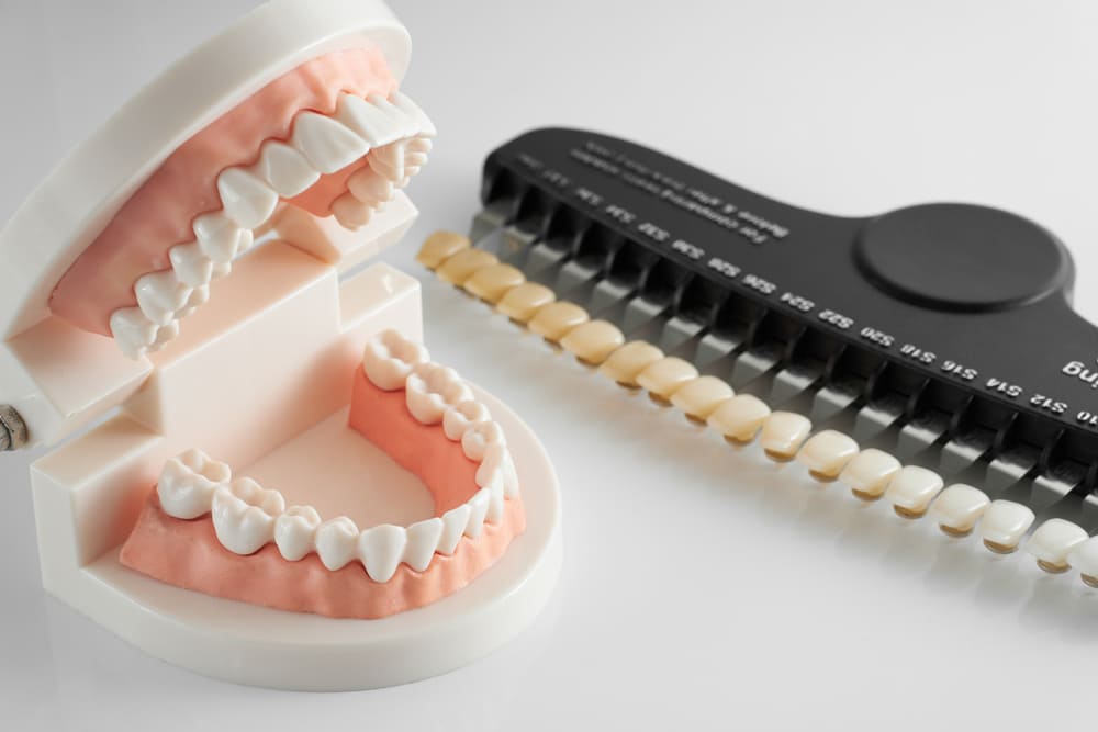 colocacion de carillas esteticas de porcelana en guillen dental