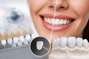 comparativa entre tratamiento de carillas dentales y blanqueamiento